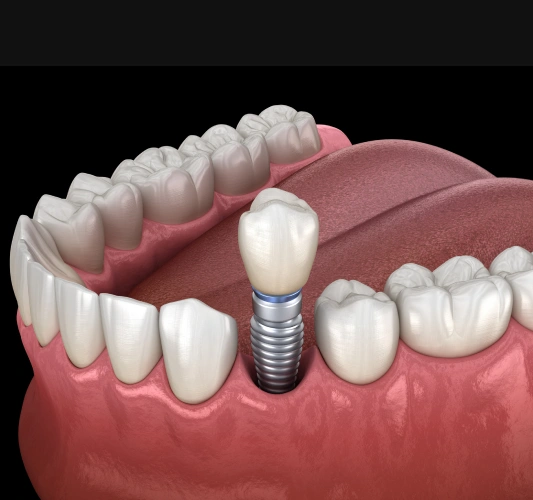 Dental Implant Options in Rocklin