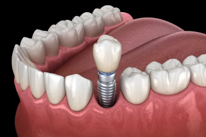 Tooth Implants in Rocklin CA