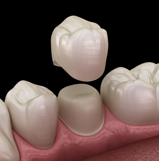 same day crowns in rocklin