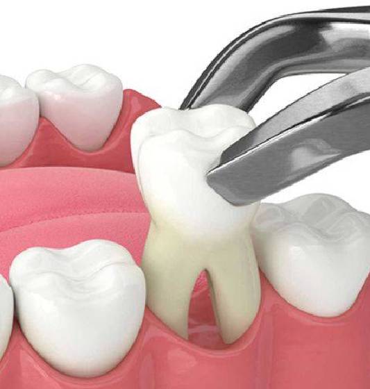 Tooth extractions in Rocklin Ca